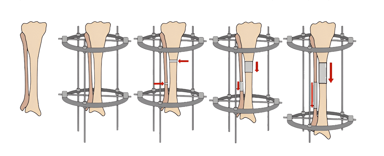 Ilizarov technique